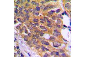 Immunohistochemical analysis of EEF2K (pS366) staining in human prostate cancer formalin fixed paraffin embedded tissue section. (EEF2K Antikörper  (pSer366))