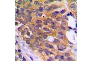 Immunohistochemical analysis of EEF2K (pS366) staining in human prostate cancer formalin fixed paraffin embedded tissue section.