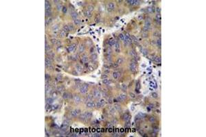 EIF3H Antibody (N-term) immunohistochemistry analysis in formalin fixed and paraffin embedded human hepatocarcinoma followed by peroxidase conjugation of the secondary antibody and DAB staining. (EIF3H Antikörper  (N-Term))