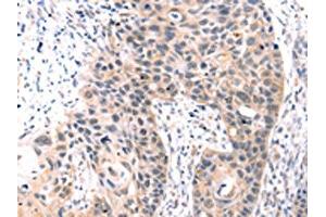 The image on the left is immunohistochemistry of paraffin-embedded Human esophagus cancer tissue using ABIN7192749(TCERG1L Antibody) at dilution 1/30, on the right is treated with synthetic peptide. (TCERG1L Antikörper)