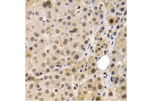 Immunohistochemistry of paraffin-embedded human liver cancer using MAGE-1/MA antibody (ABIN6132325, ABIN6143435, ABIN6143436 and ABIN6221133) at dilution of 1:200 (40x lens). (MAGEA1 Antikörper  (AA 1-309))
