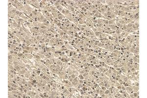 SAP62 Mouse Monoclonal Antibody at 1/100 staining human gastric cancer by IHC-P. (SF3A2 Antikörper)