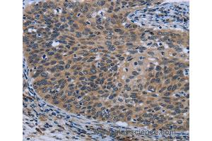 Immunohistochemistry of Human cervical cancer using AVEN Polyclonal Antibody at dilution of 1:30 (AVEN Antikörper)