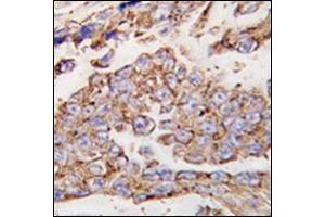 Formalin-fixed and paraffin-embedded human lung carcinoma tissue reacted with CD107a / LAMP1 Antibody (N-term) followed which was peroxidase-conjugated to the secondary antibody, followed by DAB staining.