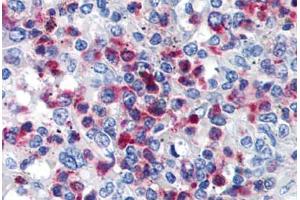 Human Spleen (formalin-fixed, paraffin-embedded) stained with CD63 antibody ABIN239811 at 10 ug/ml followed by biotinylated anti-mouse IgG secondary antibody ABIN481714, alkaline phosphatase-streptavidin and chromogen. (CD63 Antikörper)