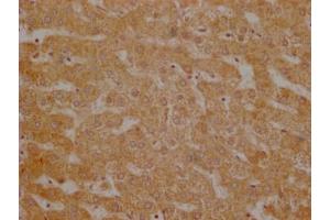 Immunohistochemistry of paraffin-embedded human breast cancer using ABIN7174308 at dilution of 1:100 (USP3 Antikörper  (C-Term))
