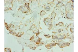 Immunohistochemistry of paraffin-embedded human breast cancer using ABIN7163824 at dilution of 1:100 (PKD1L2 Antikörper  (AA 1-306))