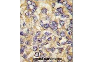 Formalin-fixed and paraffin-embedded human breast carcinoma tissue reacted with UCHL3 antibody (C-term), which was peroxidase-conjugated to the secondary antibody, followed by DAB staining. (UCHL3 Antikörper  (C-Term))