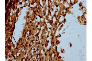 IHC image of ABIN7174180 diluted at 1:100 and staining in paraffin-embedded human melanoma performed on a Leica BondTM system.