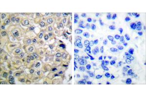 Peptide - +Immunohistochemical analysis of paraffin-embedded human breast carcinoma tissue using FGFR3 antibody. (FGFR3 Antikörper)