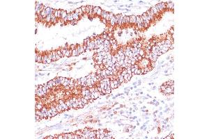 Immunohistochemistry of paraffin-embedded human colon carcinoma using ENTPD6 antibody (ABIN7266897) at dilution of 1:100 (40x lens). (ENTPD6 Antikörper  (AA 61-300))