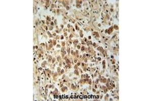 VCX1 Antibody (N-term) immunohistochemistry analysis in formalin fixed and paraffin embedded human testis carcinoma followed by peroxidase conjugation of the secondary antibody and DAB staining.