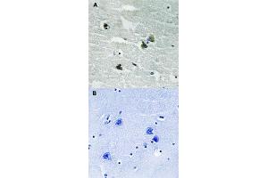 Immunohistochemical staining of human by MERTK/TYRO3 (phospho Y749/681) polyclonal antibody  without blocking peptide (A) or preincubated with blocking peptide (B) under 1:500-1000 dilution. (MERTK Antikörper  (pTyr681, pTyr749))