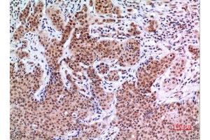 Immunohistochemistry (IHC) analysis of paraffin-embedded Human Mammary Cancer, antibody was diluted at 1:100. (EPAS1 Antikörper  (Ser343))