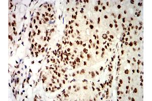 Immunohistochemical analysis of paraffin-embedded bladder cancer tissues using UHRF1 mouse mAb with DAB staining.