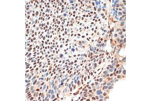 Immunohistochemistry of paraffin-embedded human esophageal cancer using KDM3B Rabbit pAb (ABIN1680577, ABIN3015976, ABIN3015977 and ABIN6219483) at dilution of 1:100 (40x lens). (KDM3B Antikörper  (AA 1059-1283))