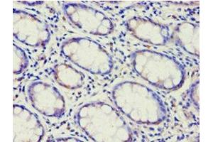 Immunohistochemistry of paraffin-embedded human colon cancer using ABIN7144925 at dilution of 1:100 (ABCF2 Antikörper  (AA 1-250))