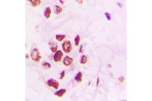 Immunohistochemical analysis of PIAS3 staining in human lung cancer formalin fixed paraffin embedded tissue section.