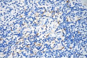 Immunohistochemistry was performed on paraffin-embedded human pancreatic adenocarcinoma using alpha glucosidase antibody (ABIN7797585), 1:200). (Rekombinanter AGLU Antikörper)