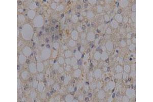 Immunohistochemical staining of human liver cancer tissue section with PRDX6 monoclonal antibody, clone 52  at 1:100 dilution.