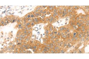 Immunohistochemistry of paraffin-embedded Human breast cancer tissue using TMEFF2 Polyclonal Antibody at dilution 1:35