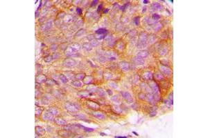Immunohistochemical analysis of GSK3 alpha (pS21) staining in human breast cancer formalin fixed paraffin embedded tissue section. (GSK3 alpha Antikörper  (N-Term, pSer21))