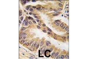 Formalin-fixed and paraffin-embedded human lung carcinoma tissue reacted with RAF1-p, which was peroxidase-conjugated to the secondary antibody, followed by DAB staining. (RAF1 Antikörper  (AA 599-628))