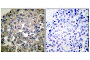 Immunohistochemical analysis of paraffin-embedded human breast carcinoma tissue using PLCG1 (epitope around residue 771) antibody (ABIN5976161). (Phospholipase C gamma 1 Antikörper  (Tyr771))