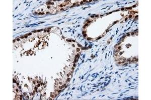 Immunohistochemical staining of paraffin-embedded Adenocarcinoma of ovary tissue using anti-APP mouse monoclonal antibody. (APP Antikörper)