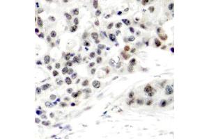 Immunohistochemistry of paraffin-embedded human breast carcinoma using Phospho-ESR1-S106 antibody (ABIN2988004). (Estrogen Receptor alpha Antikörper  (pSer106))