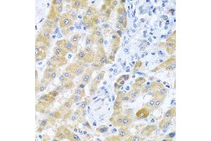 Immunohistochemistry of paraffin-embedded human liver cancer using Gm13125 antibody. (Pramel15 Antikörper  (AA 67-274))