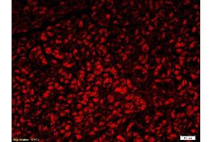 Formalin-fixed and paraffin embedded human gastric carcinoma with Anti-Fascin1 Polyclonal Antibody, Unconjugated  at 1:300, followed by conjugation to the secondary antibody Goat Anti-Rabbit IgG, PE conjugated -PE)used at 1:200 dilution for 40 minutes at 37°C. (Fascin Antikörper  (AA 11-110))