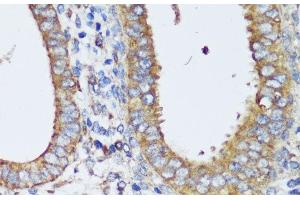 Immunohistochemistry of paraffin-embedded Human uterine cancer using ERK1 / ERK2 Polyclonal Antibody at dilution of 1:200 (40x lens). (ERK1/2 Antikörper)