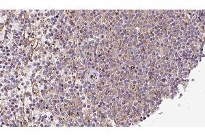 ABIN6273217 at 1/100 staining Human lymph cancer tissue by IHC-P. (CRLS1 Antikörper  (Internal Region))