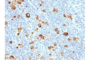 Formalin-fixed, paraffin-embedded human Hodgkin's Lymphoma stained with CD15 Rabbit Recombinant Monoclonal Antibody (FUT4/1478R). (Rekombinanter CD15 Antikörper)