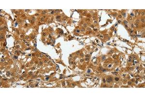 Immunohistochemistry of paraffin-embedded Human lung cancer tissue using AKAP12 Polyclonal Antibody at dilution 1:40 (AKAP12 Antikörper)