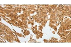 Immunohistochemistry of paraffin-embedded Human cervical cancer tissue using RETNLB Polyclonal Antibody at dilution 1:40 (RETNLB Antikörper)