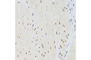 Immunohistochemistry of paraffin-embedded human gastric cancer using CSRP3 Antibody (ABIN2562048) at dilution of 1:100 (40x lens). (CSRP3 Antikörper)