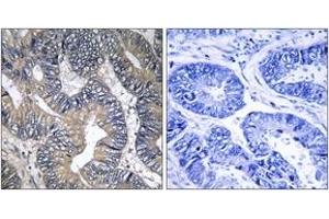 Immunohistochemistry analysis of paraffin-embedded human colon carcinoma tissue, using GTPBP2 Antibody.