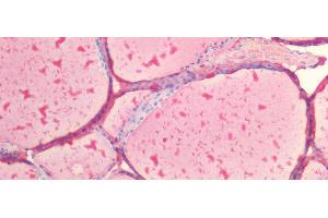 Detection of TG in Human Thyroid Tissue using Polyclonal Antibody to Thyroglobulin (TG) (Thyroglobulin Antikörper  (AA 2083-2333))