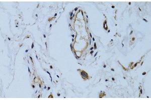 Immunohistochemistry of paraffin-embedded Human colon carcinoma using MCAM Polyclonal Antibody at dilution of 1:100 (40x lens). (MCAM Antikörper)