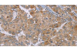 Immunohistochemistry of paraffin-embedded Human liver cancer using ACTN2 Polyclonal Antibody at dilution of 1:30 (ACTN2 Antikörper)