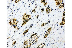 Anti-splicing factor 1 antibody, IHC(P) IHC(P): Human Lung Cancer Tissue