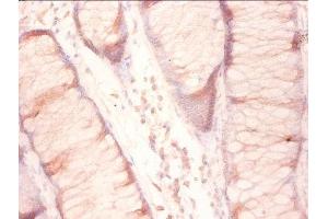 Immunohistochemistry of paraffin-embedded human colon cancer using ABIN7142788 at diluton of 1:50
