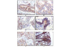 Immunohistochemical analysis of paraffin-embedded human gastric adenocarcinoma(A), colon adenocarcinoma(B), endometrial carcinoma(uterus)(C), ovary adenocarcinoma(D), lung squamous cell carcinoma(E), stomach epithelium mucosae(F), showing membrane localization using IGF1R antibody with DAB staining.