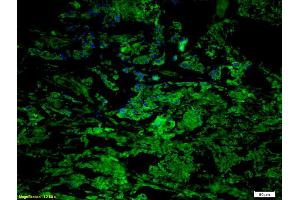 Formalin-fixed and paraffin embedded human gastric carcinoma labeled with Anti CCR7/CD197 Polyclonal Antibody, Unconjugated (ABIN674724) at 1:200 followed by conjugation to the secondary antibody Goat Anti-Rabbit IgG, Cy5 conjugated used at 1:200 dilution (CCR7 Antikörper  (AA 25-59))