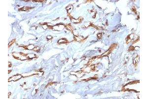 Formalin-fixed, paraffin-embedded human Angiosarcoma stained with CD34 Recombinant Rabbit Monoclonal Antibody (HPCA1/2598R). (Rekombinanter CD34 Antikörper)