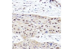 Immunohistochemistry of paraffin-embedded human esophageal cancer using PSMB2 Rabbit pAb (ABIN6129442, ABIN6146314, ABIN6146316 and ABIN6221150) at dilution of 1:100 (40x lens). (PSMB2 Antikörper  (AA 1-201))