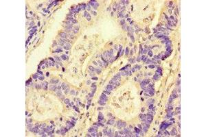 Immunohistochemistry of paraffin-embedded human colon cancer using ABIN7161435 at dilution of 1:100 (NRP2 Antikörper  (AA 60-209))