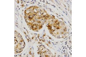 Immunohistochemistry of paraffin-embedded human stomach cancer using OLR1 antibody at dilution of 1:200 (x400 lens). (OLR1 Antikörper  (AA 58-273))